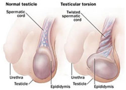 Painful Scrotal Swelling Part I – Testicular Torsion