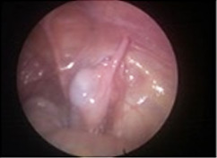 Intra-abdominal testis